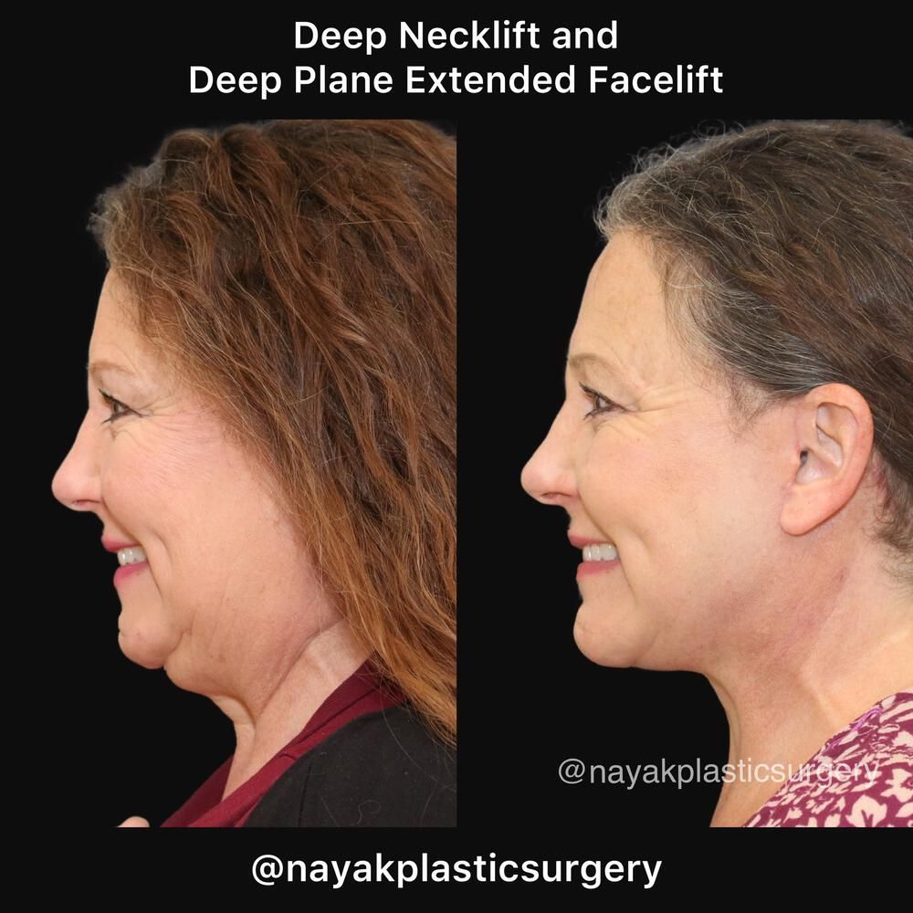 Deep Necklift Before & After