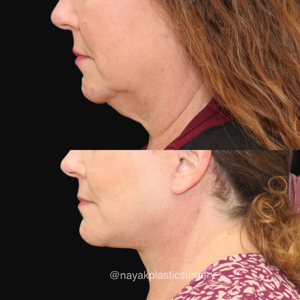 Deep Necklift Before & After