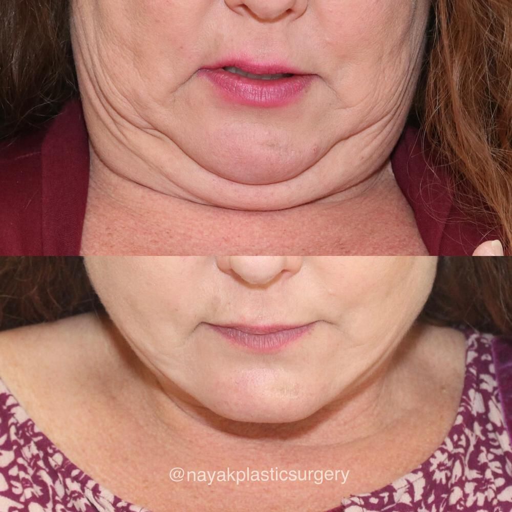 Deep Necklift Before & After