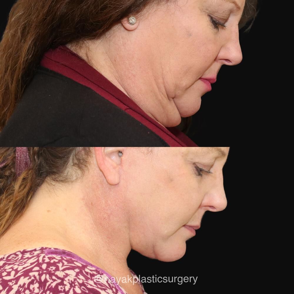 Deep Necklift Before & After