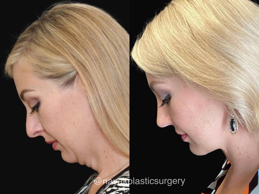 Deep Necklift Before & After