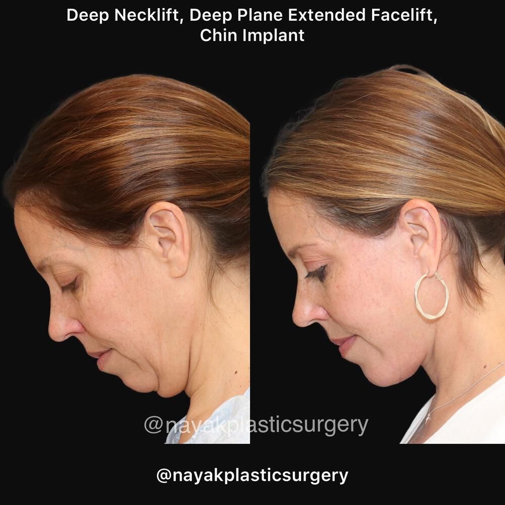 Deep Necklift Before & After