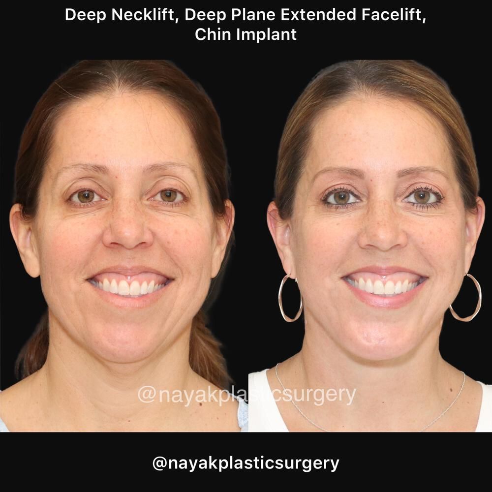 Deep Necklift Before & After