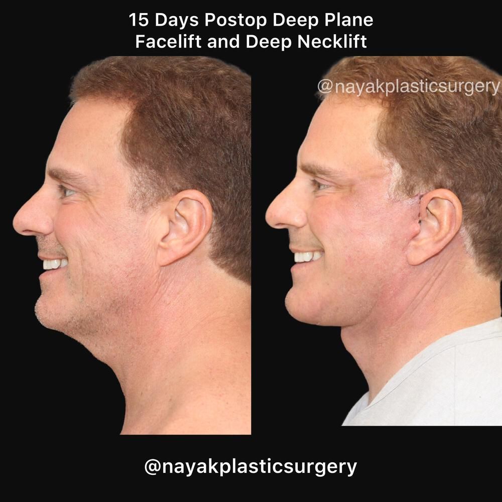 Deep Necklift Before & After