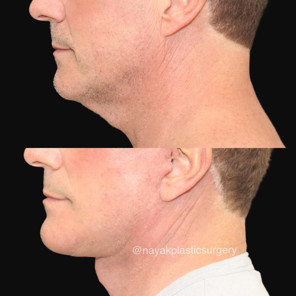 Deep Necklift Before & After