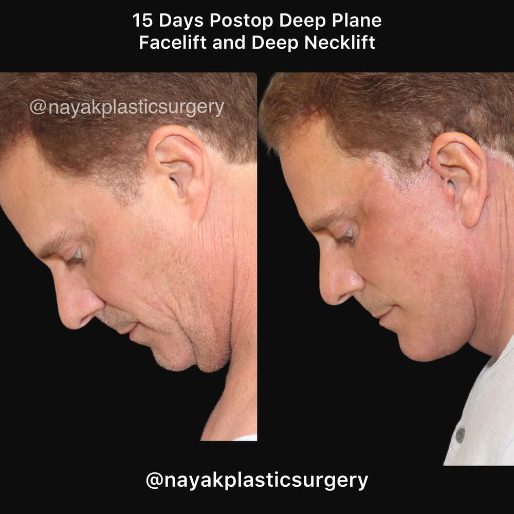 Deep Necklift Before & After