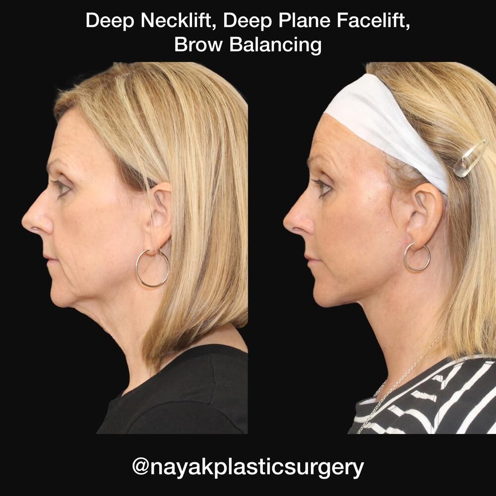Deep Necklift Before & After