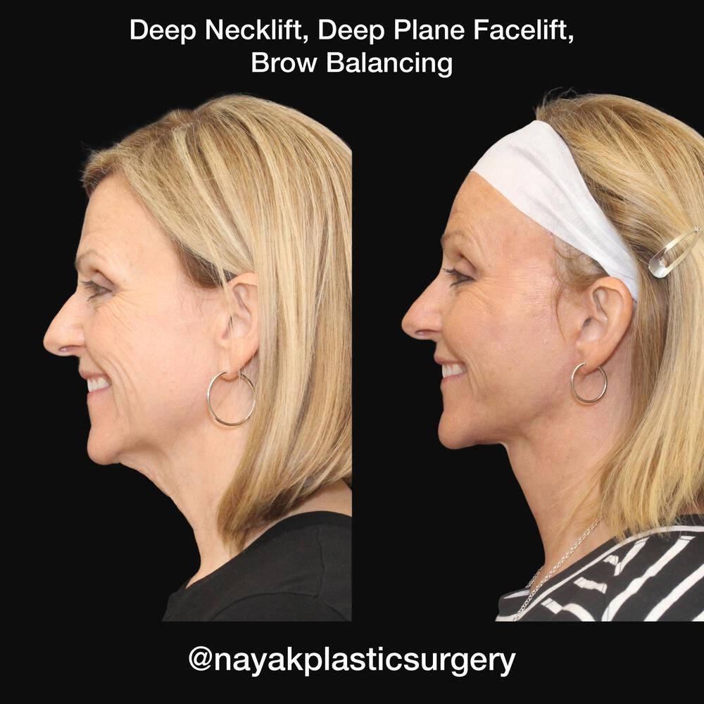 Deep Necklift Before & After