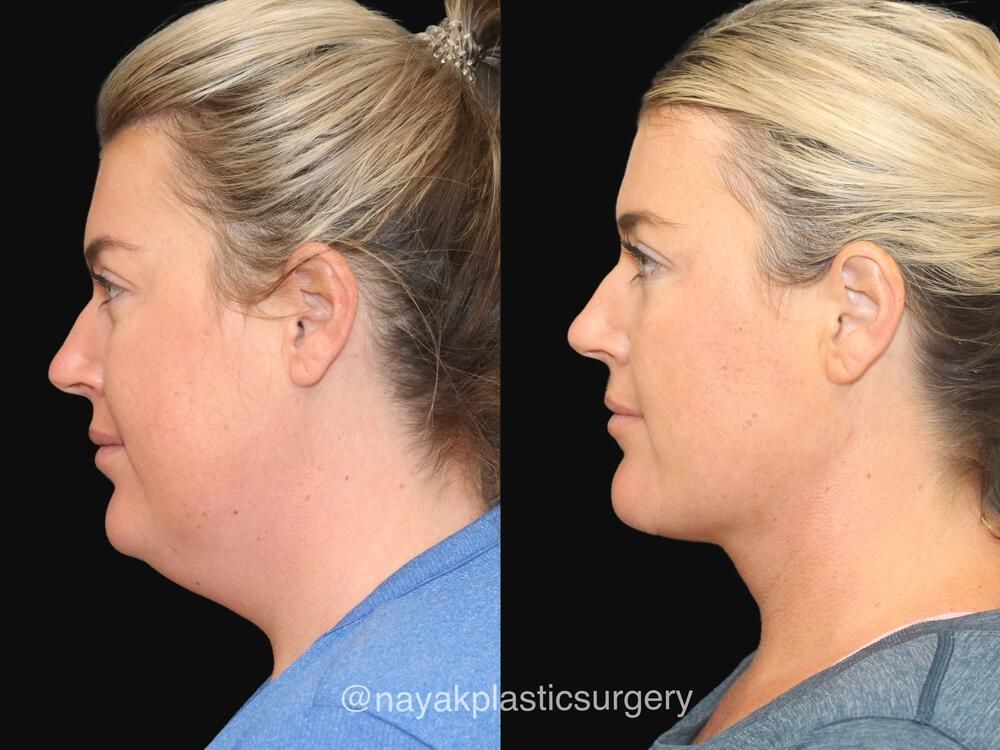 Deep Necklift Before & After