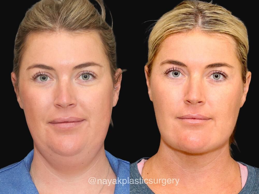 Deep Necklift Before & After