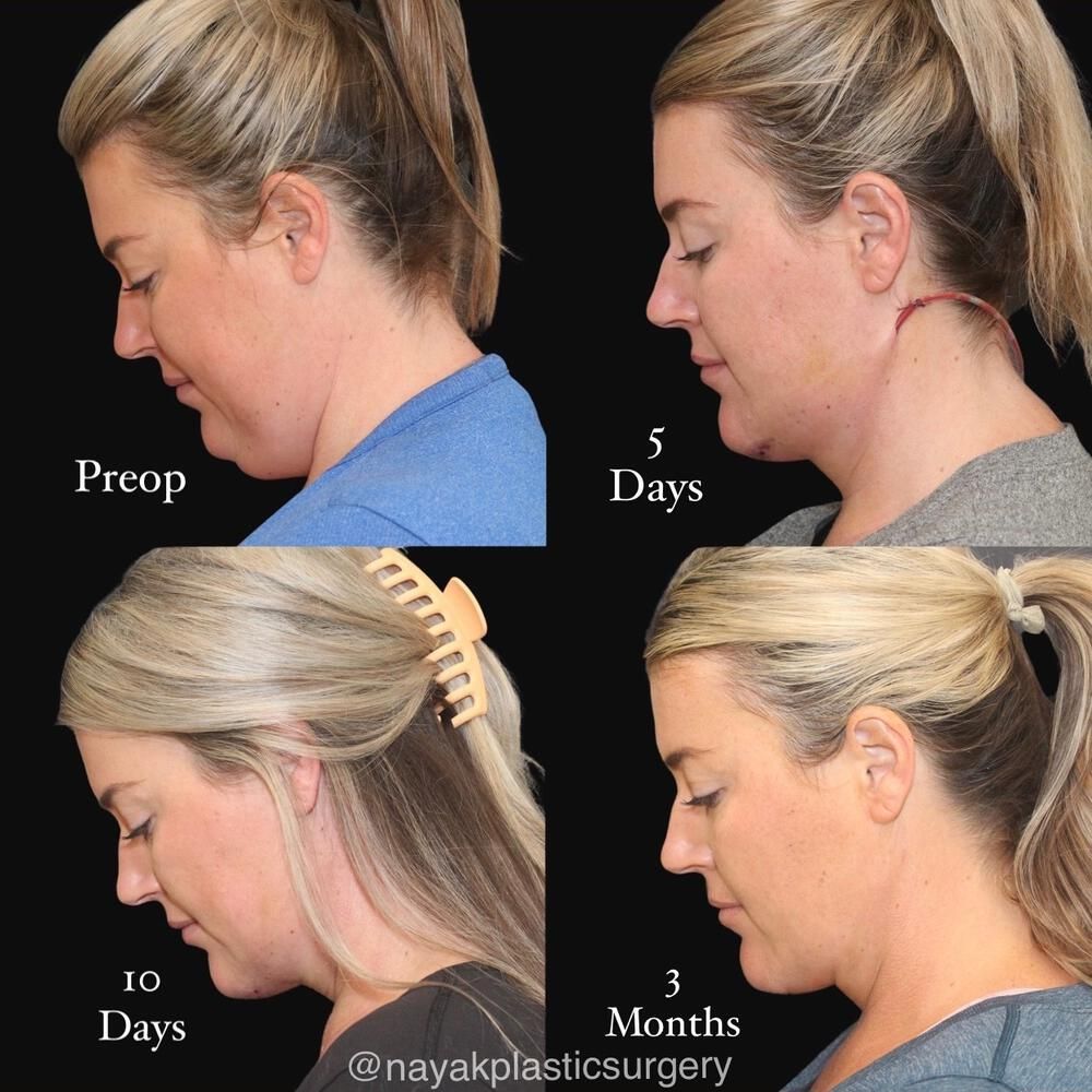 Deep Necklift Before & After