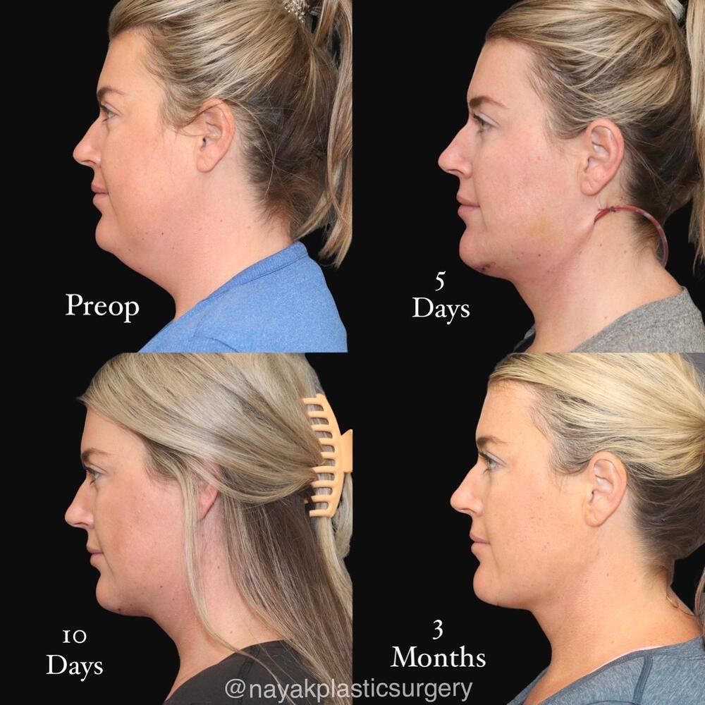 Deep Necklift Before & After