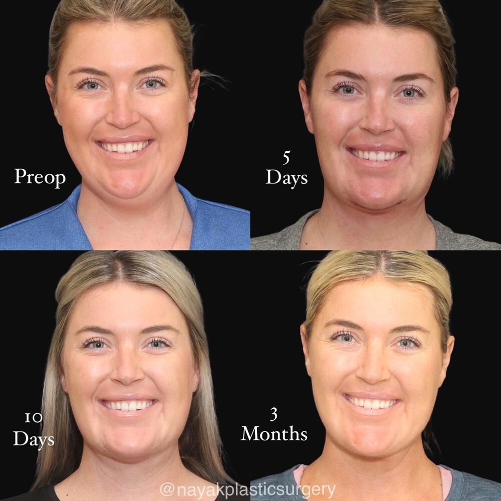 Deep Necklift Before & After