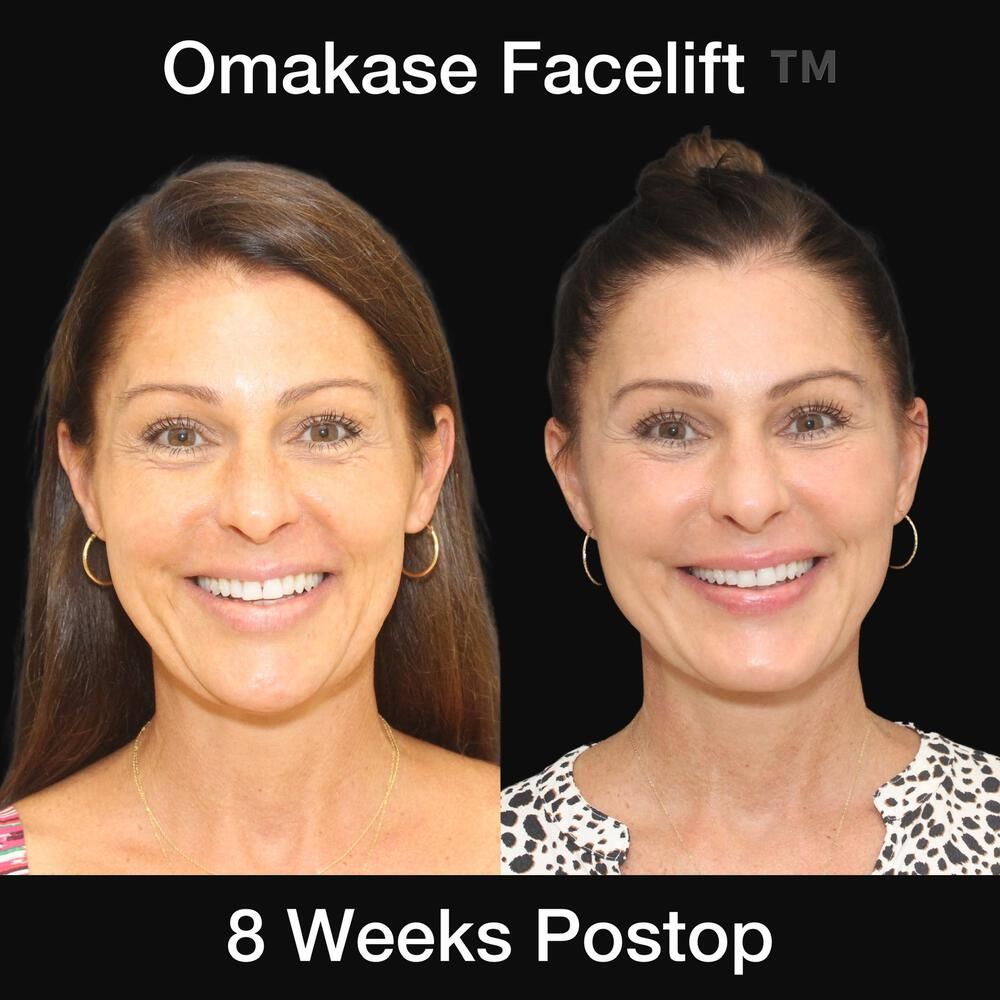 Deep Necklift Before & After