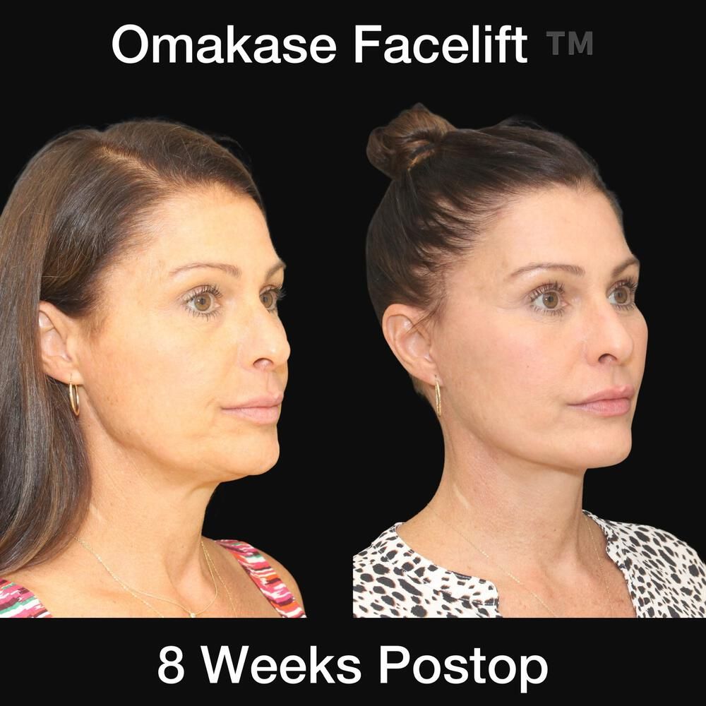 Deep Necklift Before & After