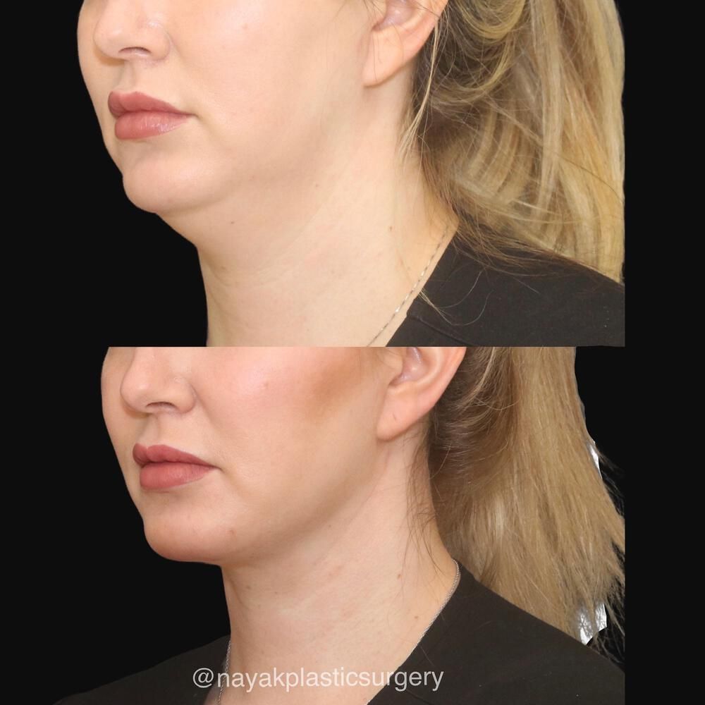 Deep Necklift Before & After