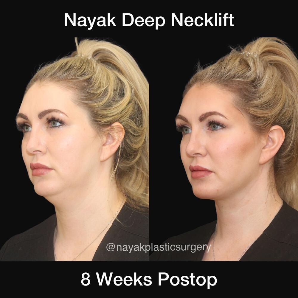 Deep Necklift Before & After