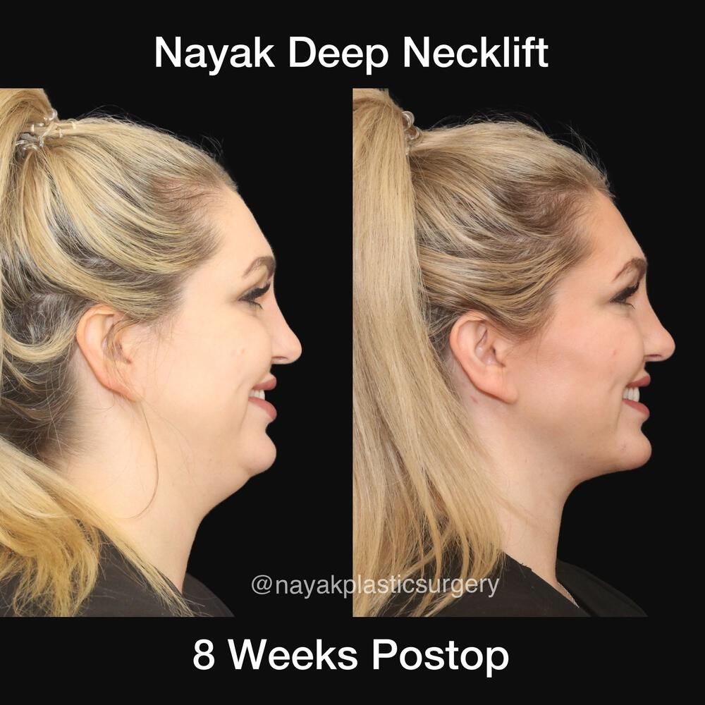 Deep Necklift Before & After
