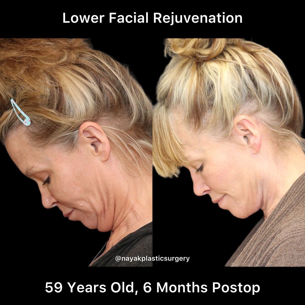 Deep Necklift Before & After