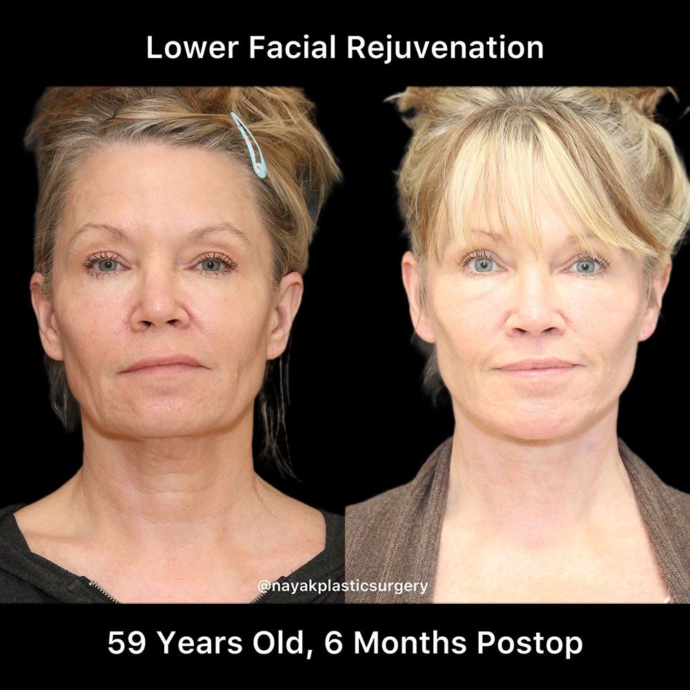 Deep Necklift Before & After