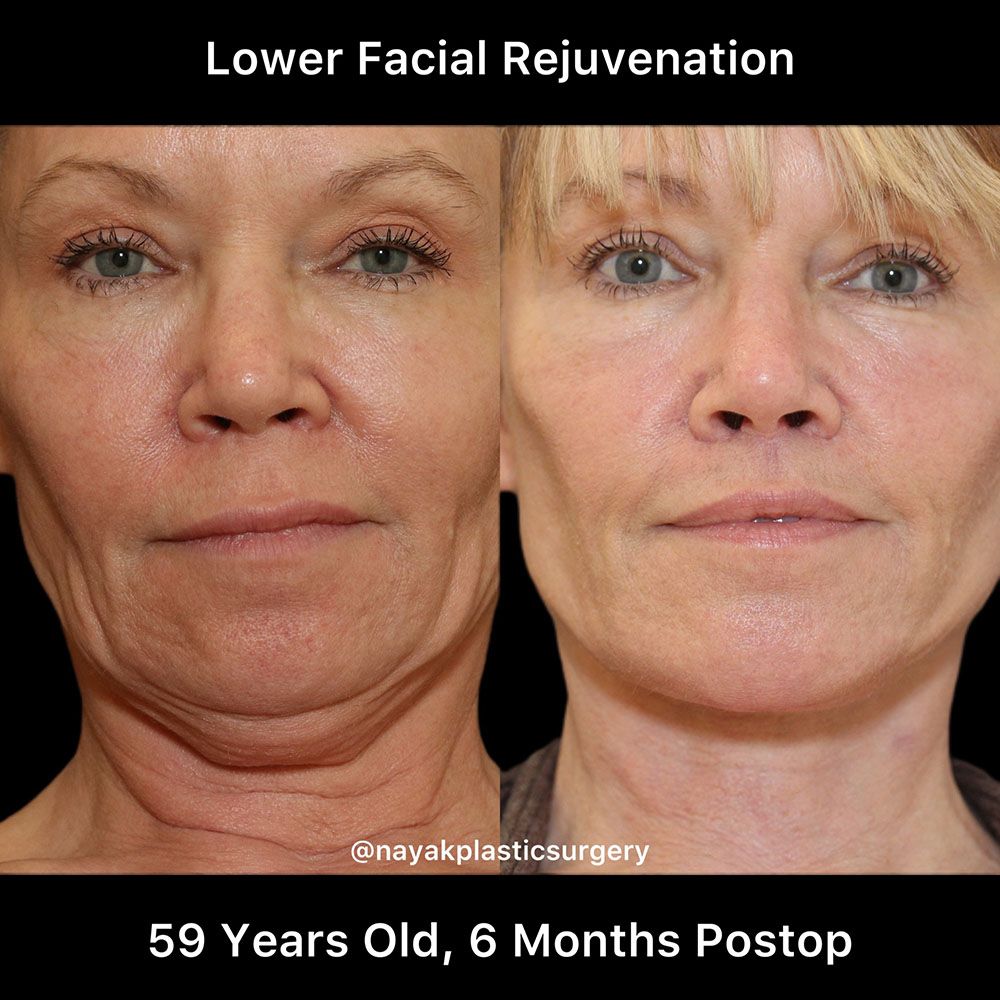 Deep Necklift Before & After