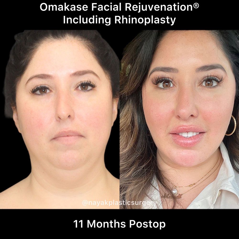 Deep Necklift Before & After