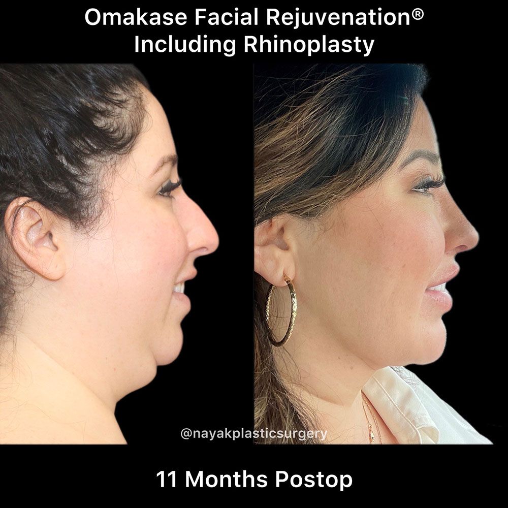 Deep Necklift Before & After