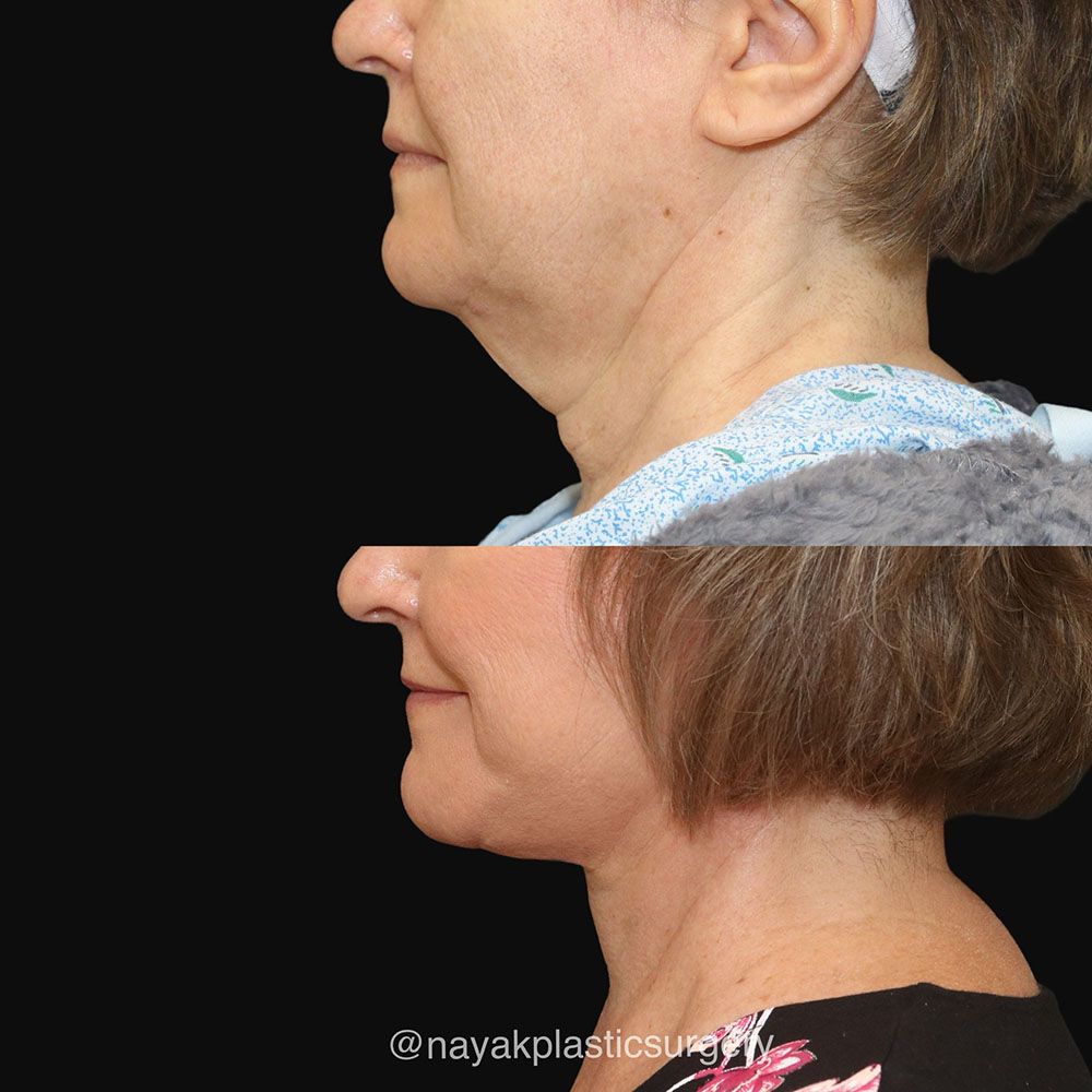 Deep Necklift Before & After