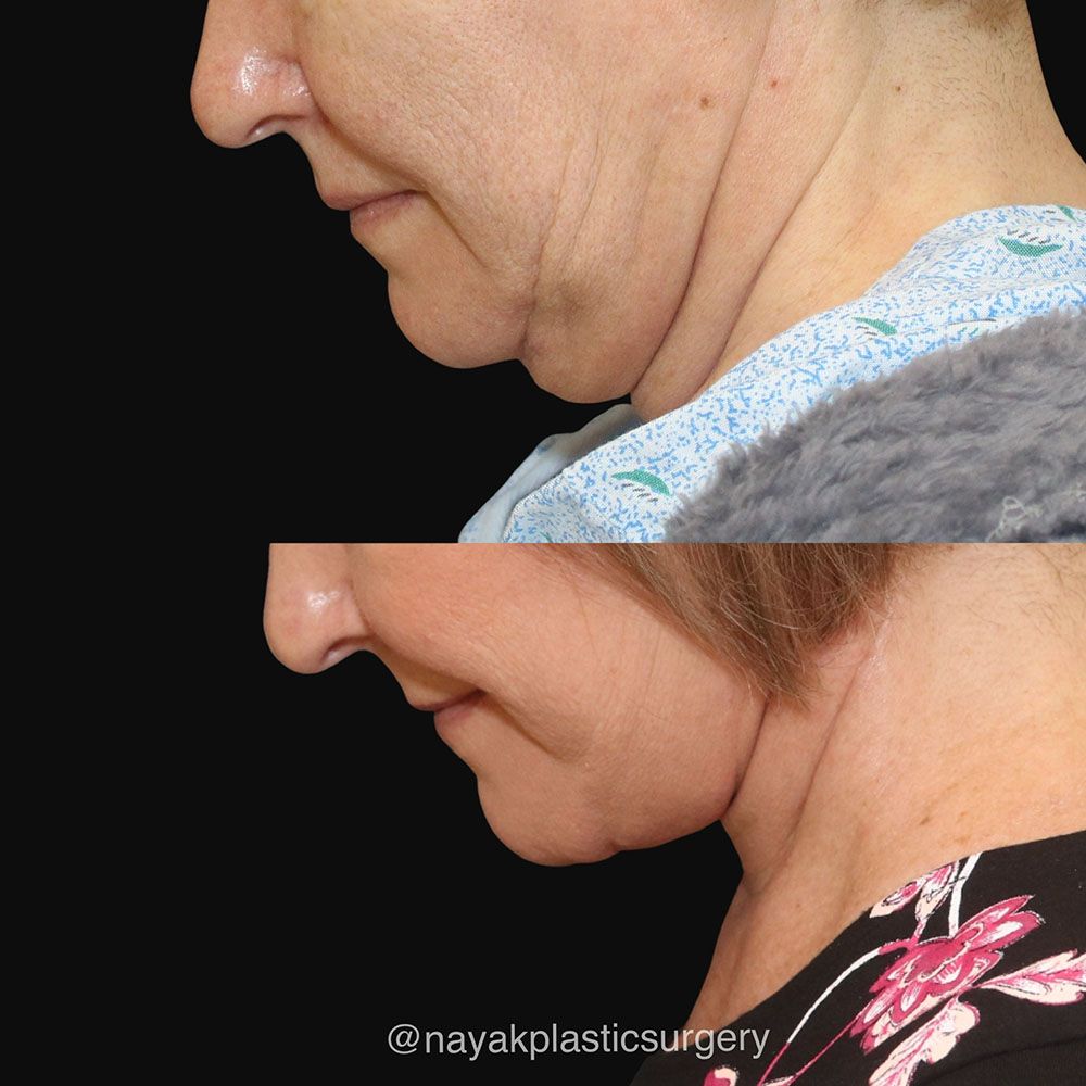 Deep Necklift Before & After