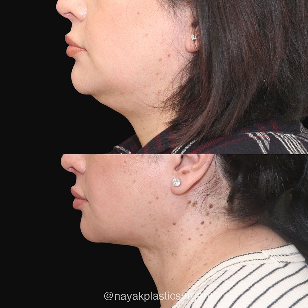 Deep Necklift Before & After