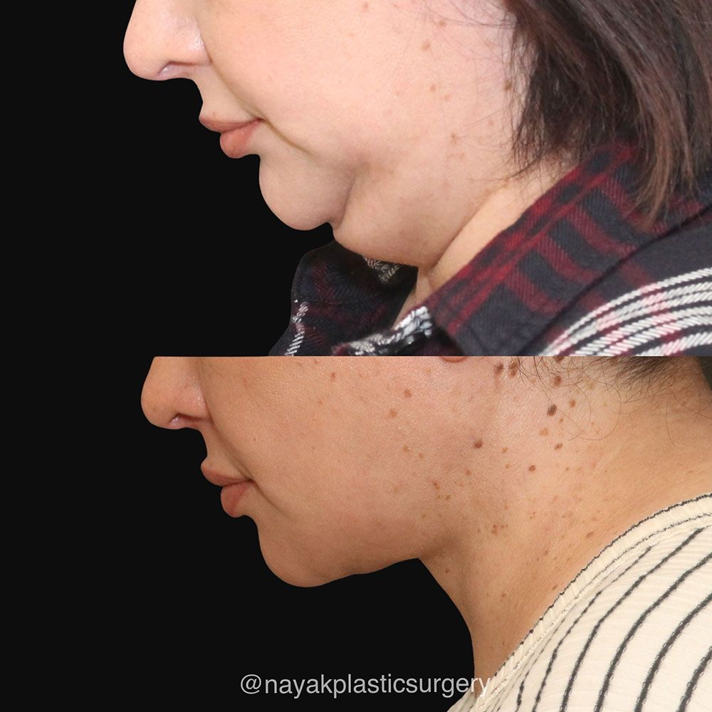 Deep Necklift Before & After