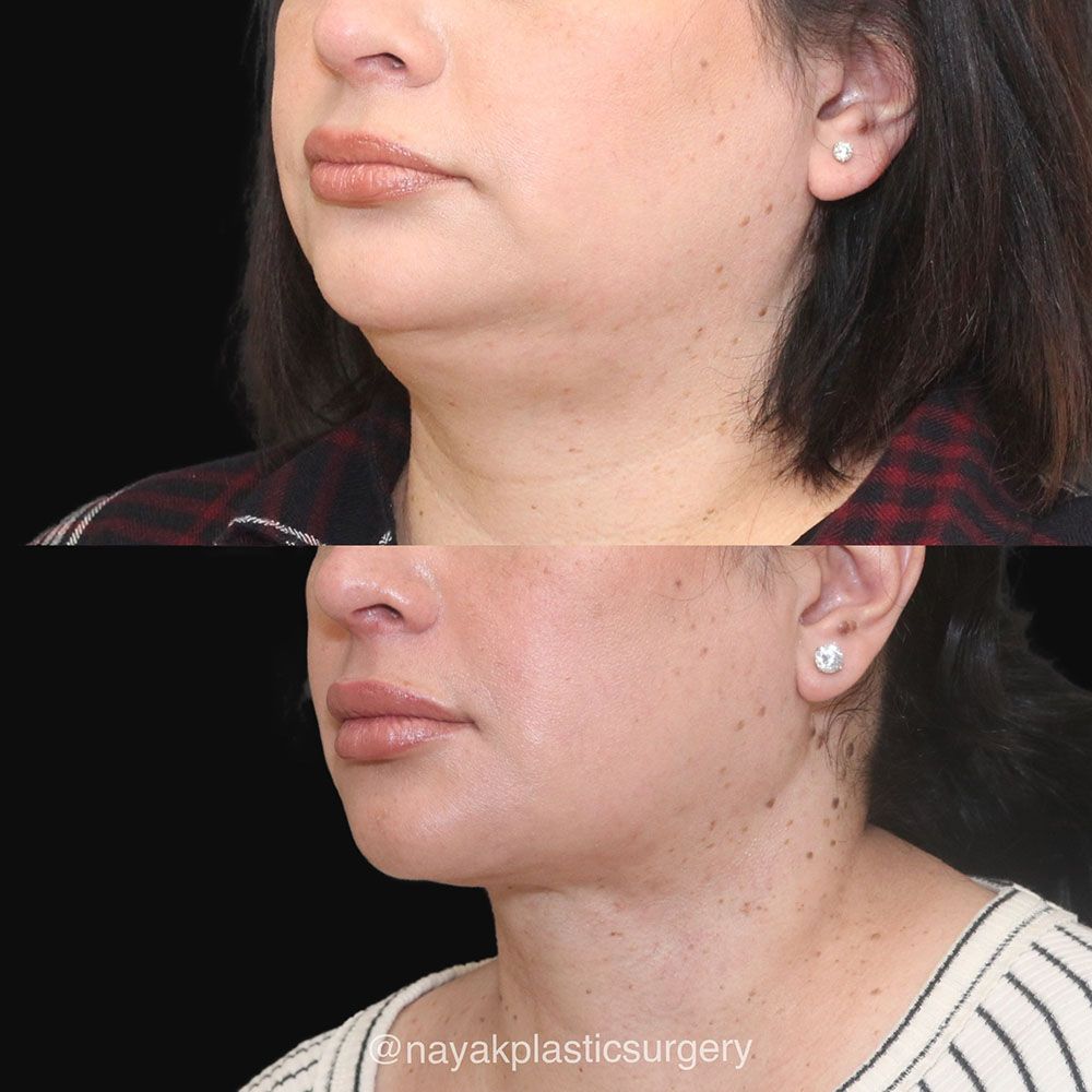 Deep Necklift Before & After