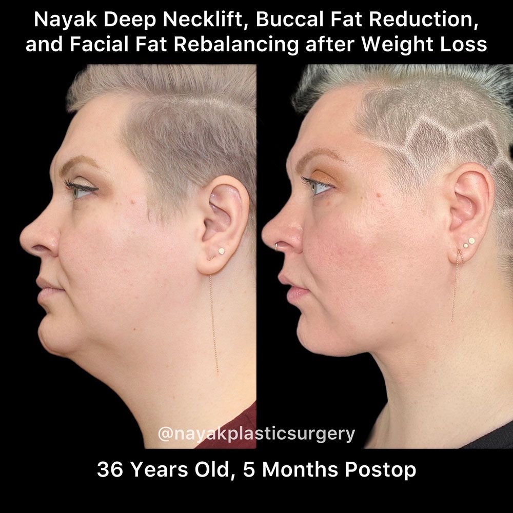 Deep Necklift Before & After