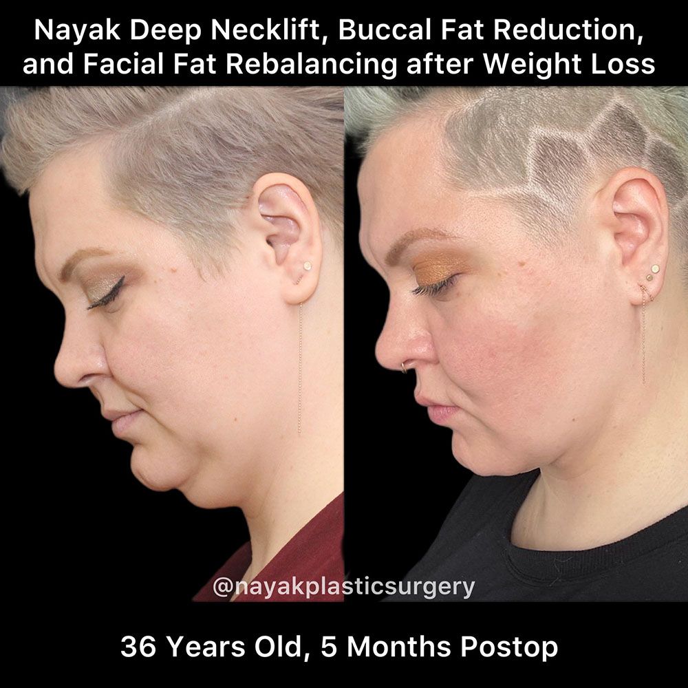 Deep Necklift Before & After
