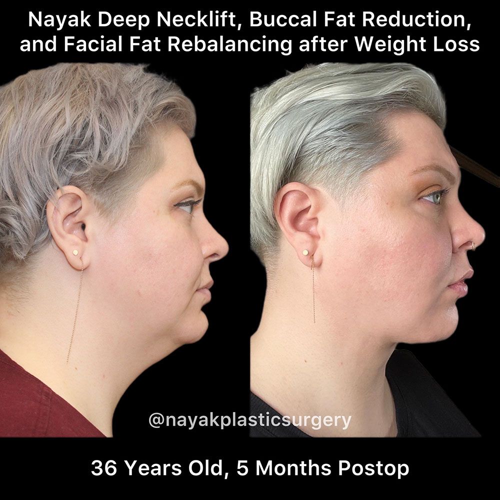 Deep Necklift Before & After