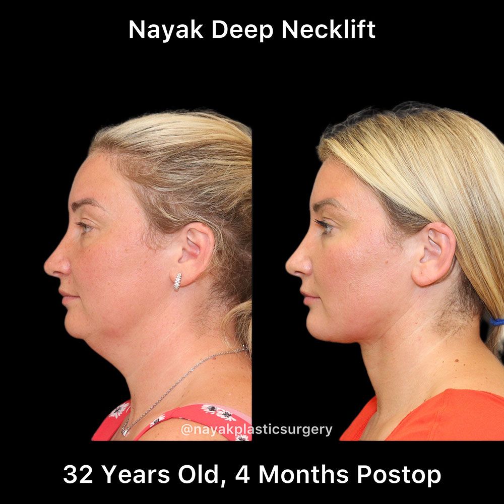 Deep Necklift Before & After
