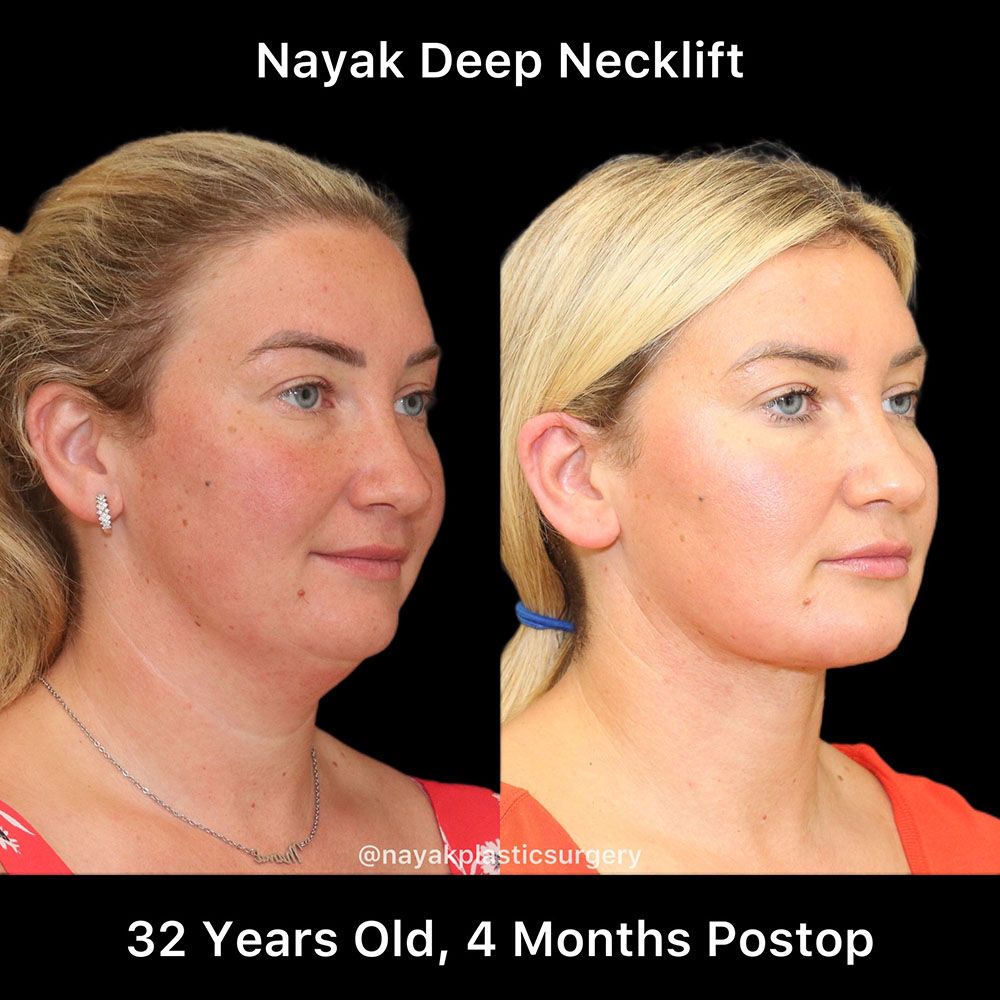 Deep Necklift Before & After