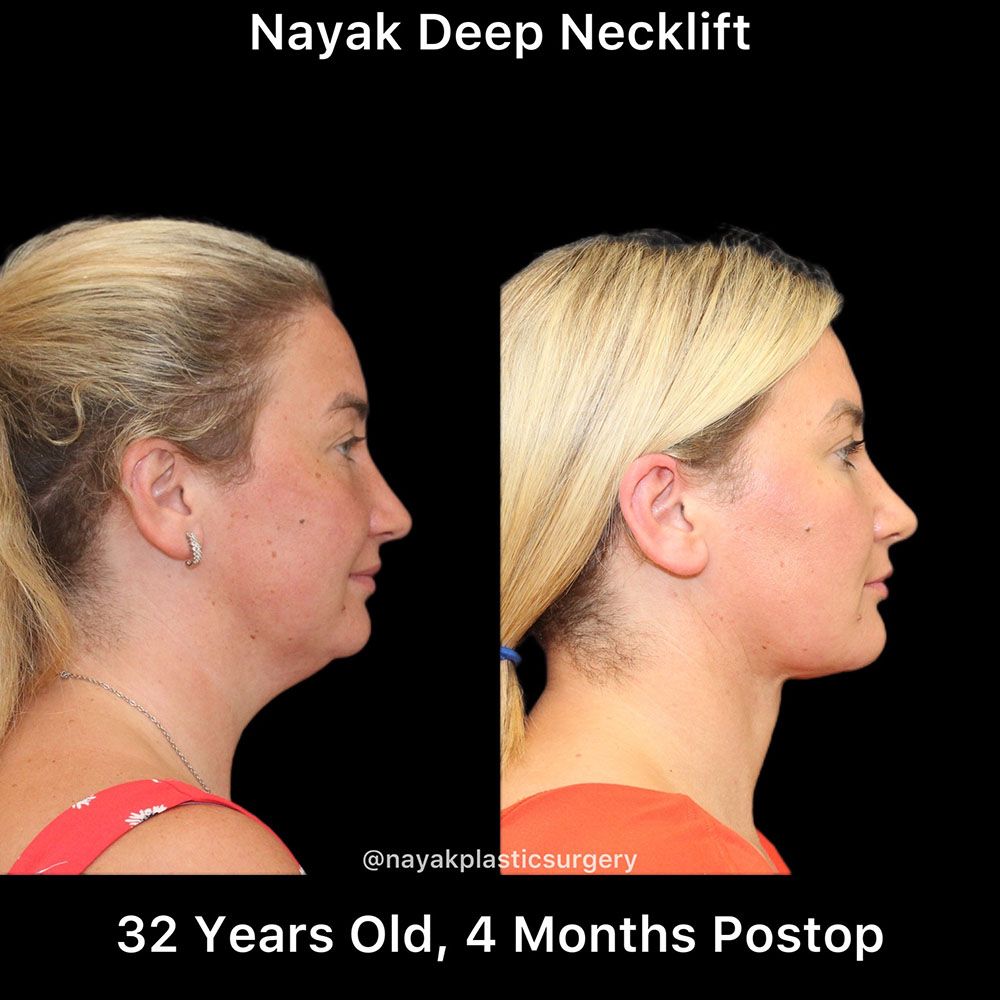 Deep Necklift Before & After
