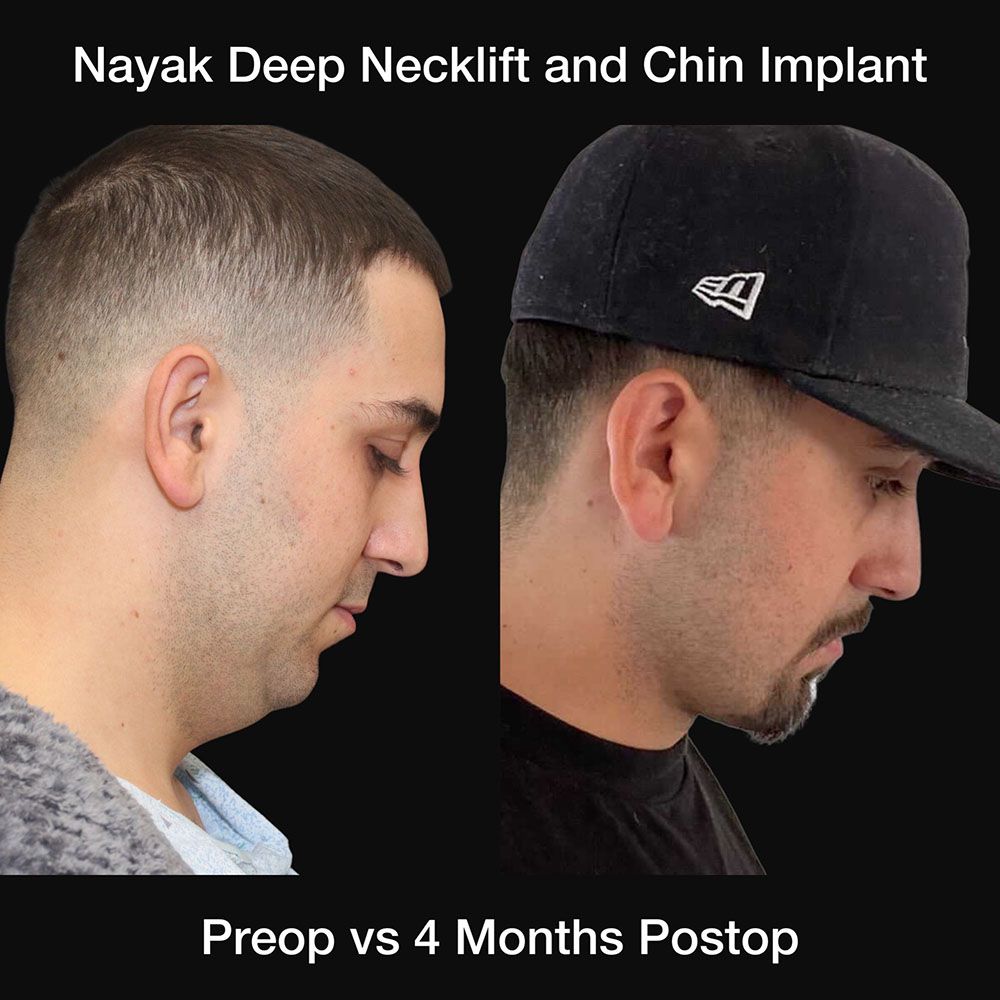 Deep Necklift Before & After