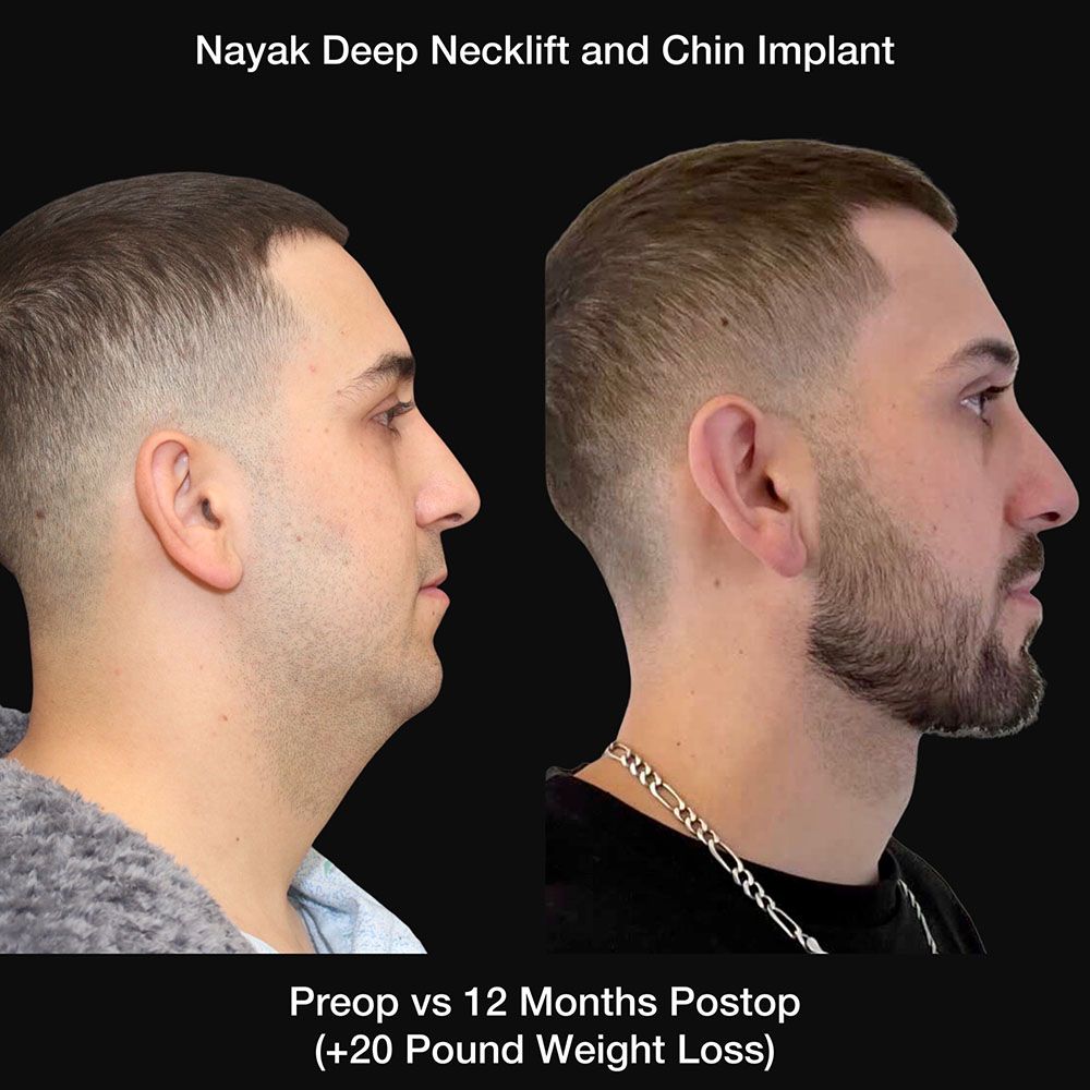 Deep Necklift Before & After