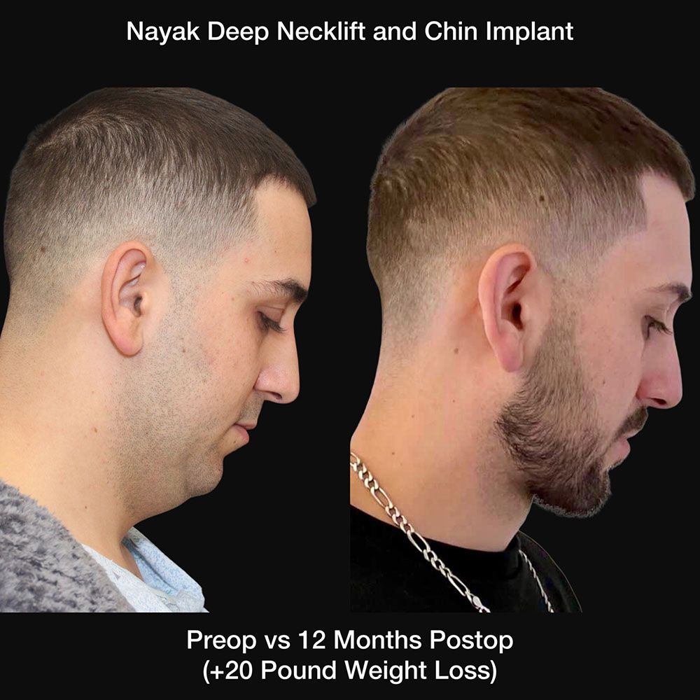 Deep Necklift Before & After