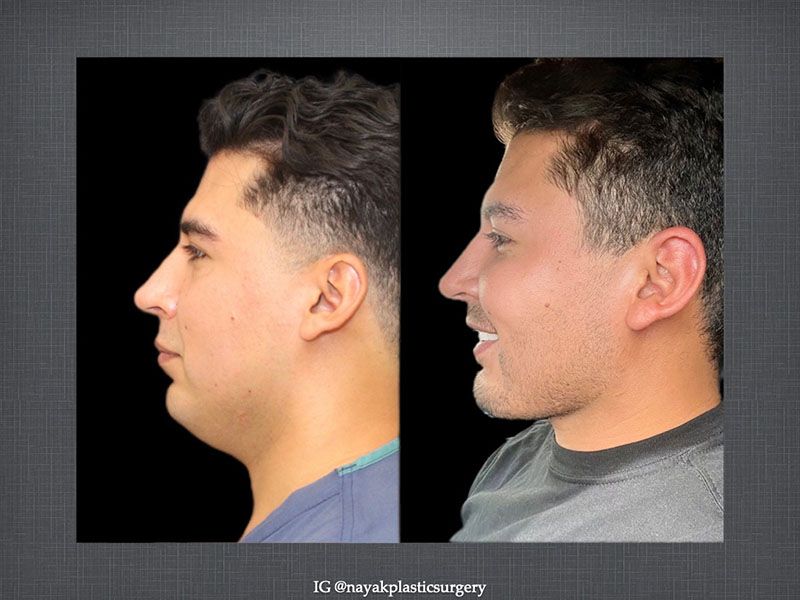 Deep Necklift Before & After