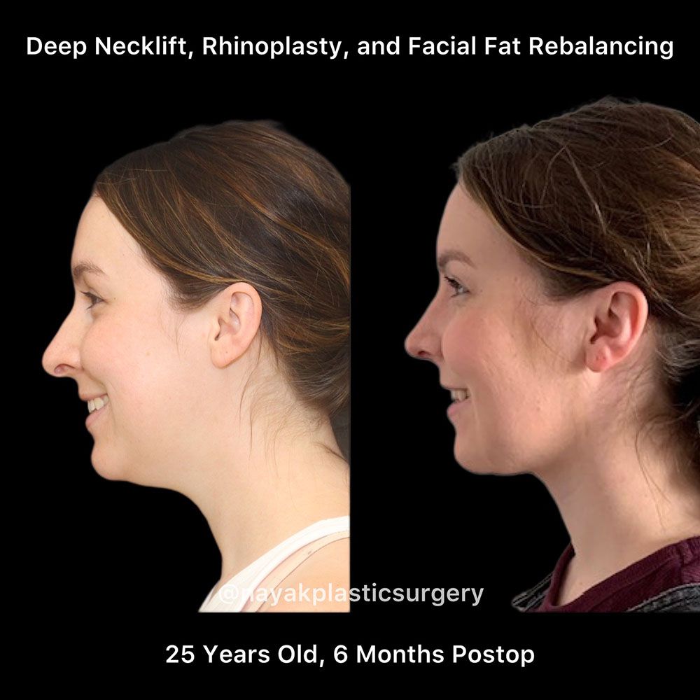 Deep Necklift Before & After