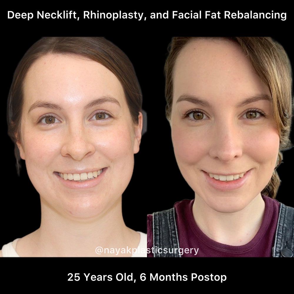Deep Necklift Before & After