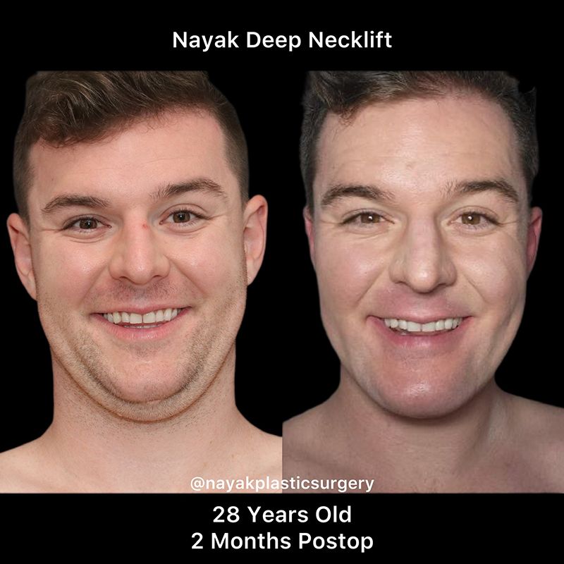 Deep Necklift Before & After