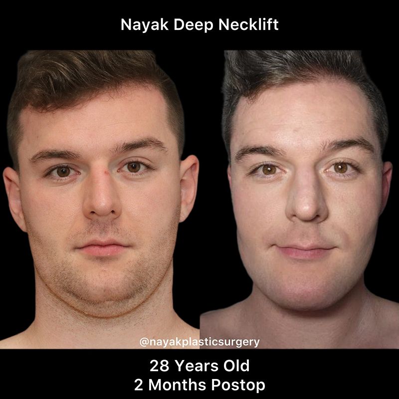 Deep Necklift Before & After
