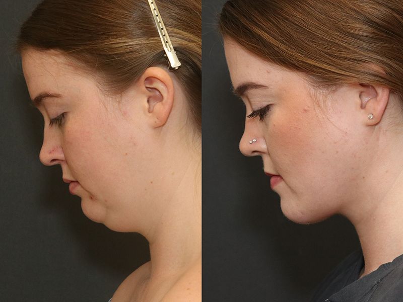Deep Necklift Before & After