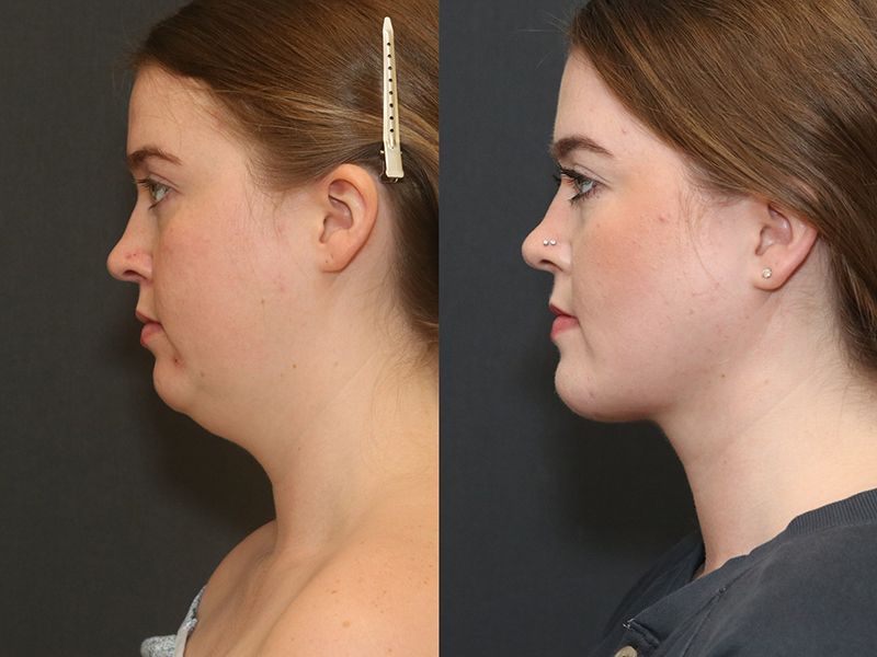 Deep Necklift Before & After