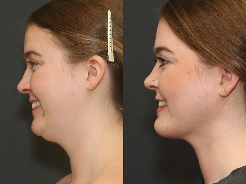 Deep Necklift Before & After