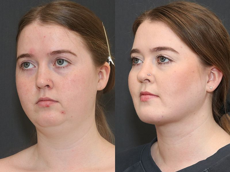Deep Necklift Before & After